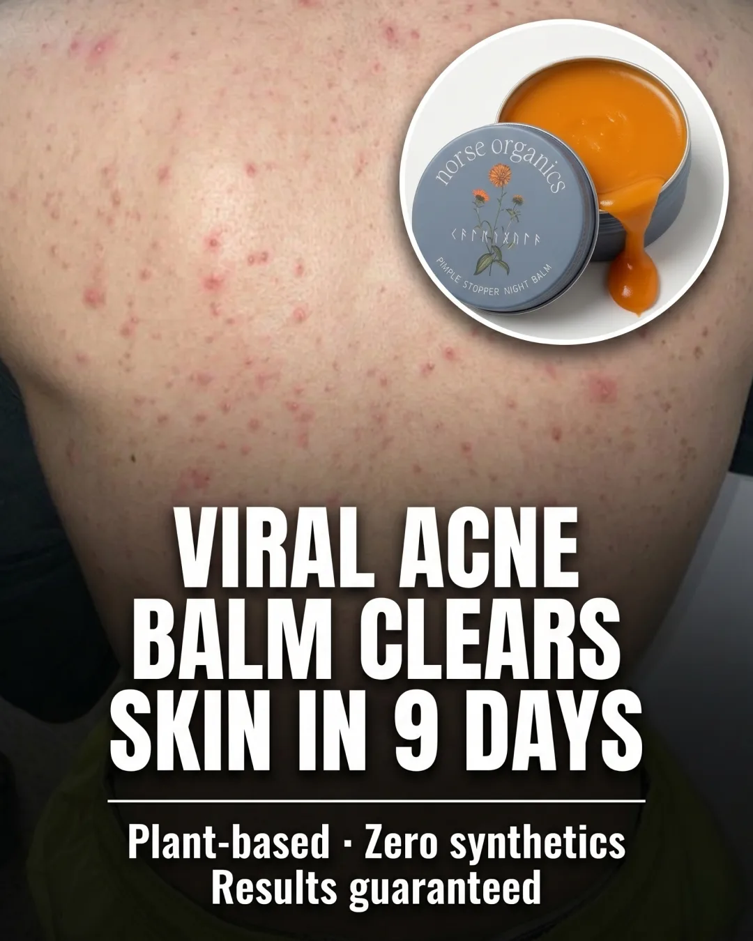 Acne Balm Offer Ad