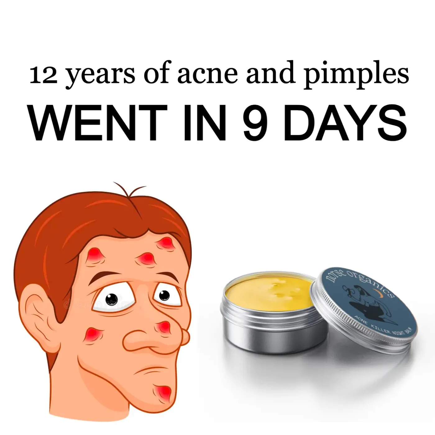 Acne Solution Offer Ad